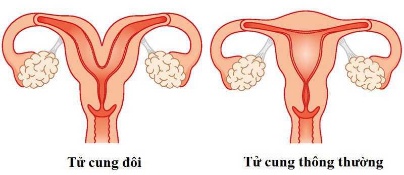 Tử cung đôi và những ảnh hưởng tới sức khỏe sinh sản