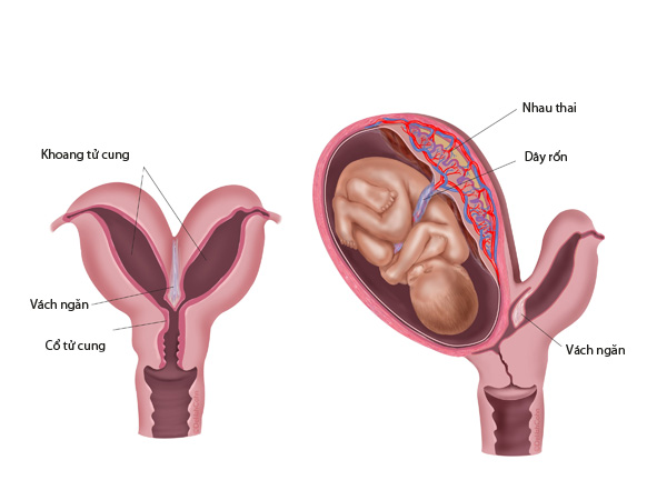 Tử cung đôi và những ảnh hưởng tới sức khỏe sinh sản