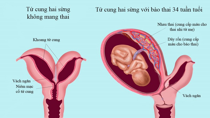 Tử cung hai sừng là gì? Tử cung hai sừng ảnh hưởng như nào tới việc mang thai?