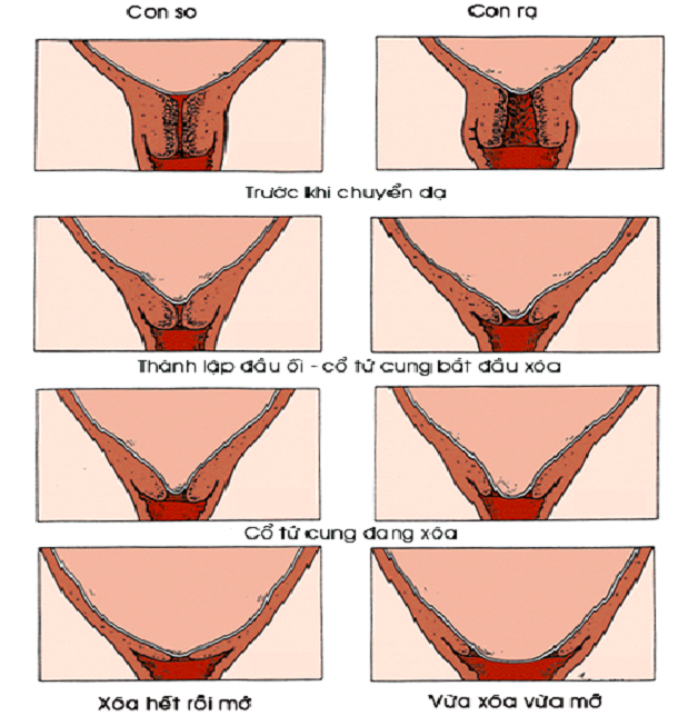 Tử cung mở khi chuyển dạ: Dấu hiệu nhận biết và những lưu ý