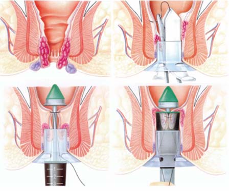 Tự khám trĩ và cách điều trị hiệu quả