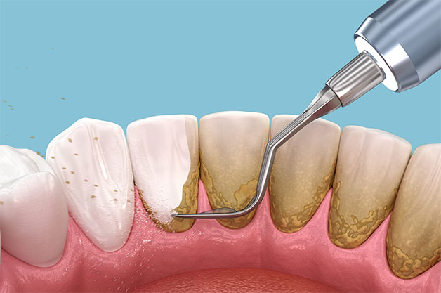 Tự lấy cao răng – Những điều nên biết