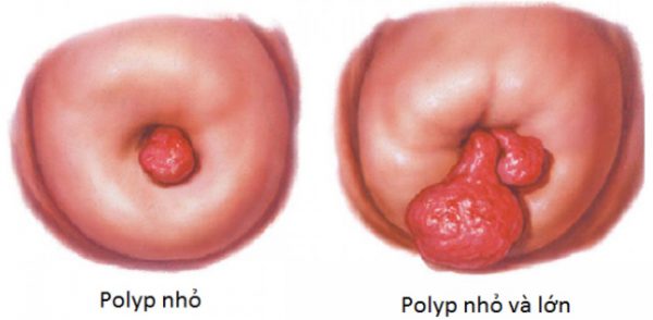 Tư vấn thắc mắc: Polyp cổ tử cung có thai được không?