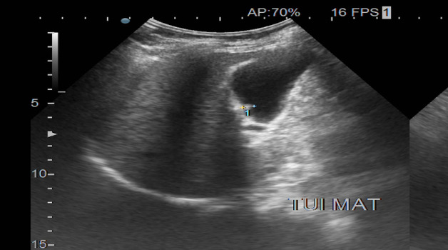 Túi mật có polyp có nguy hiểm không và những điều cần biết