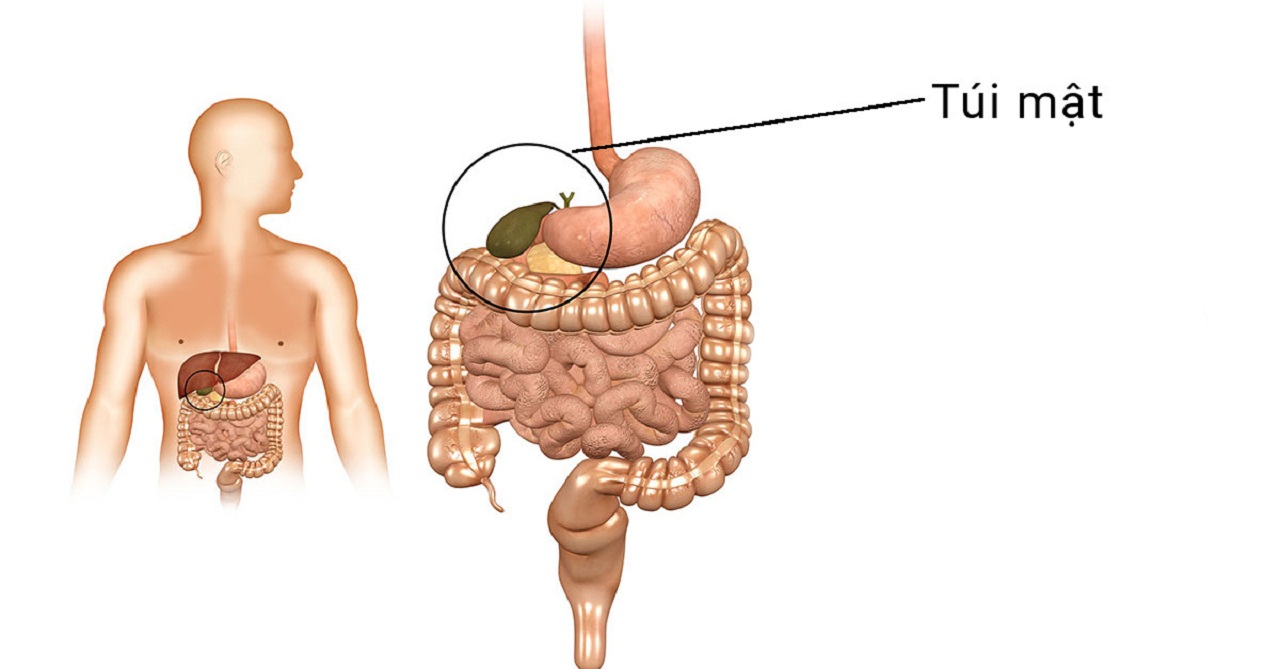 Túi mật có polyp: nguyên nhân, biến chứng và hướng điều trị