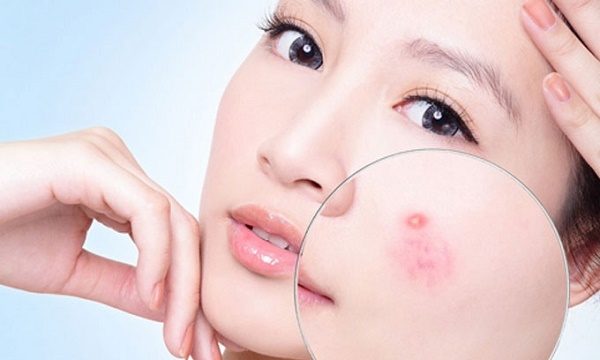 Tưởng bị mụn trứng cá, ai ngờ là… ung thư da