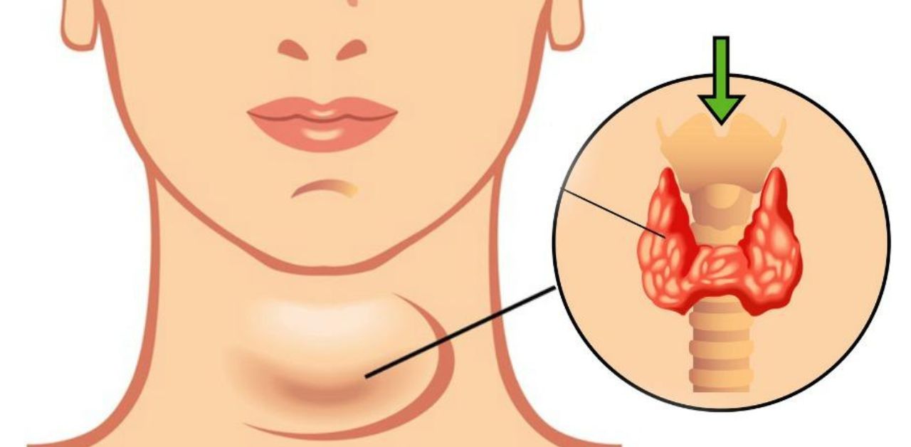 Tuyến giáp lớn biểu hiện của bệnh lý nào?