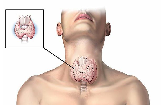 Tuyến giáp lớn biểu hiện của bệnh lý nào?