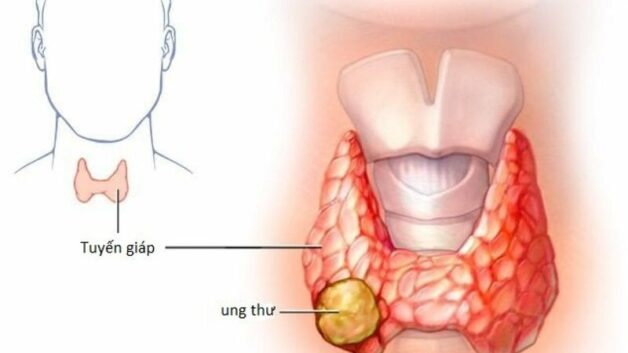 Tuyến giáp nhu mô không đều cảnh báo dấu hiệu gì?