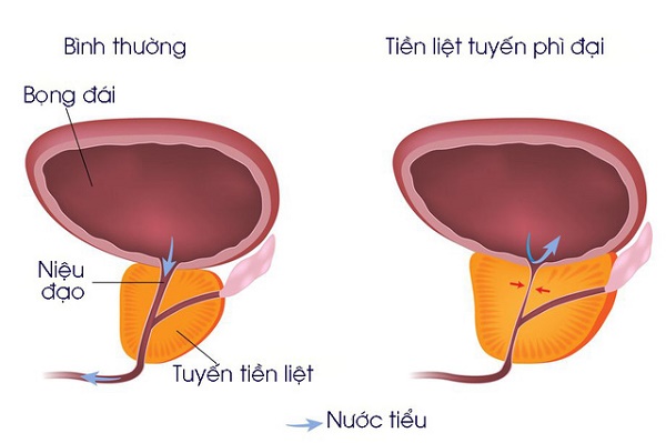 Tuyến tiền liệt phình to là do đâu?