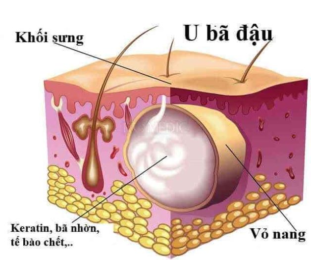 U bã đậu có nguy hiểm không?