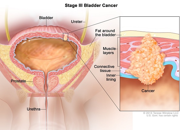 U bàng quang ác tính là gì?