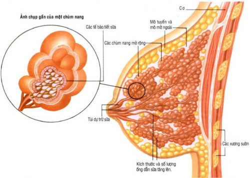 U đa nang tuyến vú là thế nào?