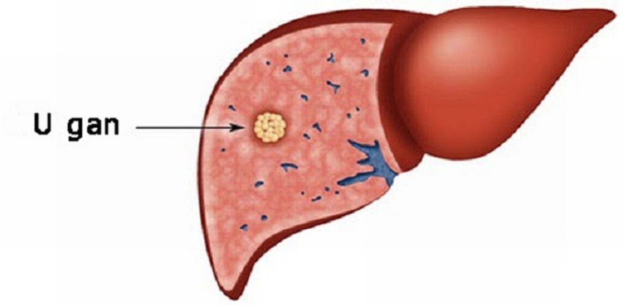 U gan có nguy hiểm không và những điều cần biết