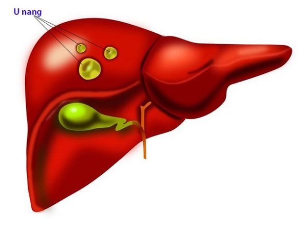 U gan có nguy hiểm không và những điều cần biết