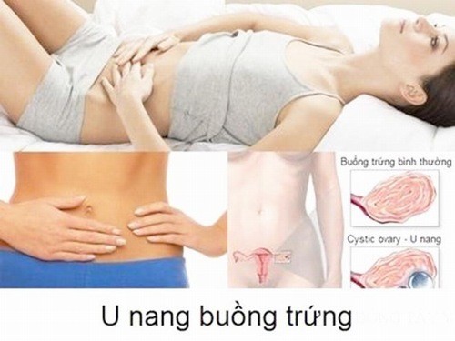 U nang buồng trứng có con được không?Phòng ngừa u nang