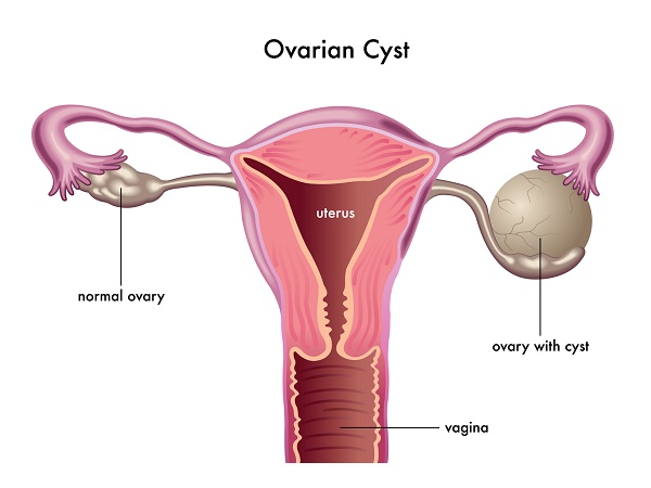 U nang buồng trứng có gây vô sinh không?