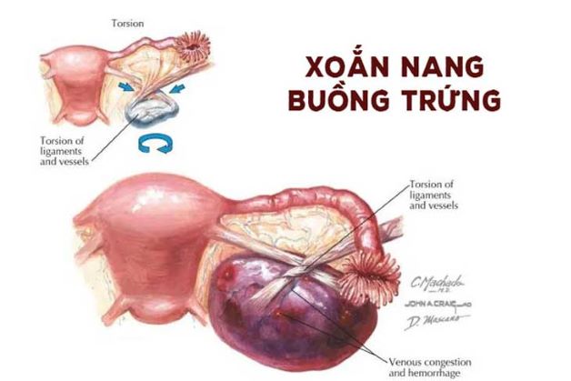 U nang buồng trứng có vách ngăn có nguy hiểm không?