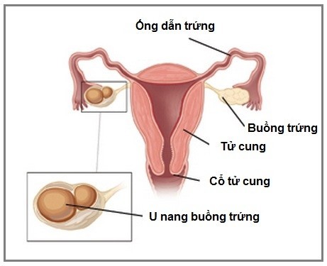 U nang buồng trứng làm sao để phát hiện?