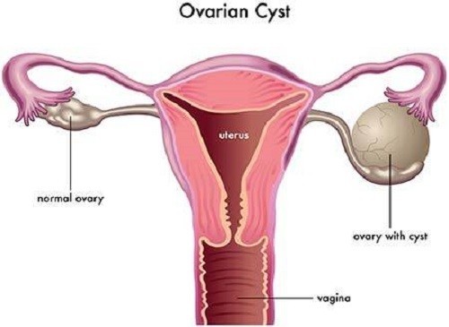 U nang buồng trứng phải và những điều cần biết