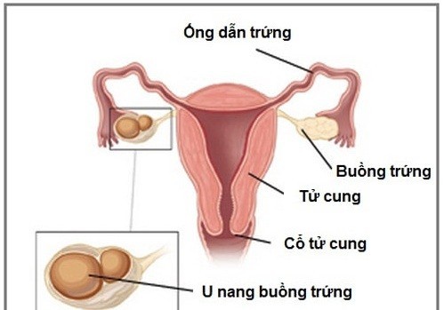 U nang buồng trứng trái có nguy hiểm không