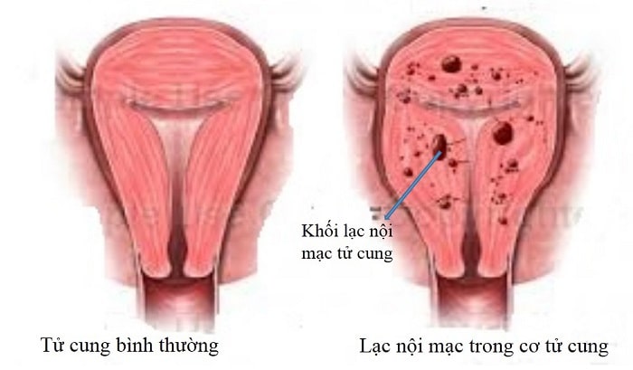 U nang buồng trứng và lạc nội mạc tử cung khác nhau thế nào?