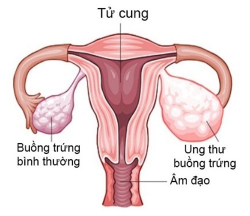 U nang buồng trứng và những điều bạn cần biết