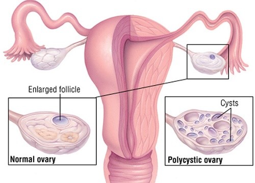 U nang buồng trứng và những điều cần biết