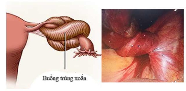 U nang buồng trứng xoắn là gì? Cách phòng ngừa hiệu quả