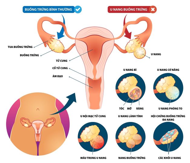 U nang buồng trứng xuất huyết có nguy hiểm không?