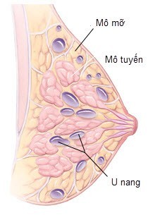 U nang tuyến vú – Nguyên nhân, triệu chứng và cách điều trị