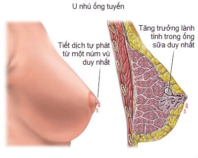 U nhú trong ống sữa là gì? Nguyên nhân, triệu chứng