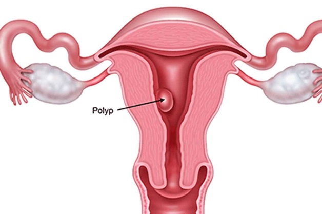 U polyp tử cung và những điều cần biết