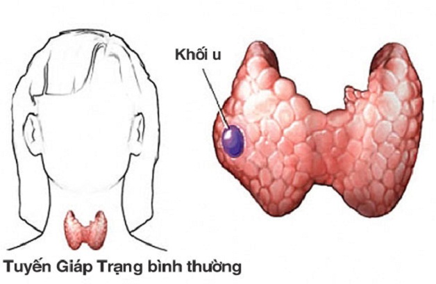 U tuyến giáp có lây không? Cách phòng tránh bệnh hiệu quả