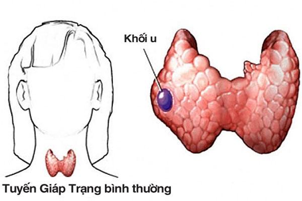 U tuyến giáp lành tính kiêng ăn gì và nên ăn gì? – Góc giải đáp