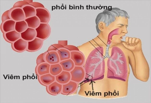 U tuyến thượng thận là gì? Nguyên nhân và triệu chứng bệnh