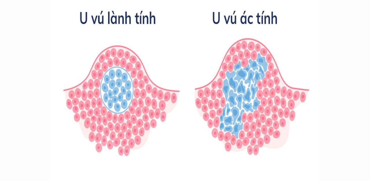 U tuyến vú lành tính và ác tính khác nhau như nào?