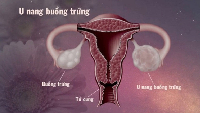 U xơ buồng trứng hay u nang buồng trứng? Tổng quan về bệnh