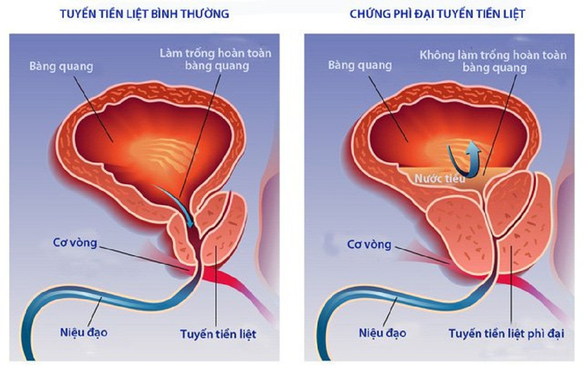 U xơ phì đại tuyến tiền liệt – nỗi lo của nam giới