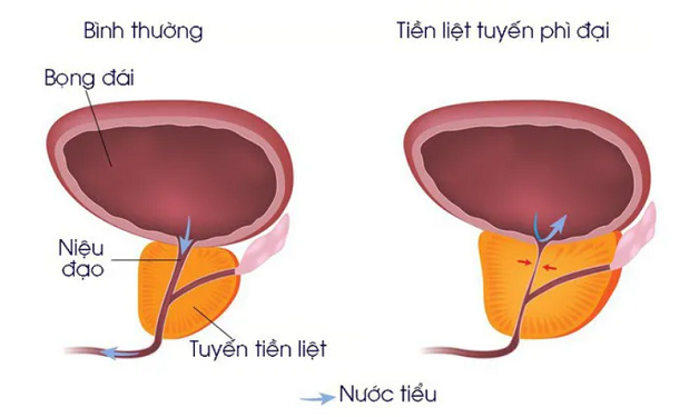 U xơ phì đại tuyến tiền liệt – nỗi lo của nam giới