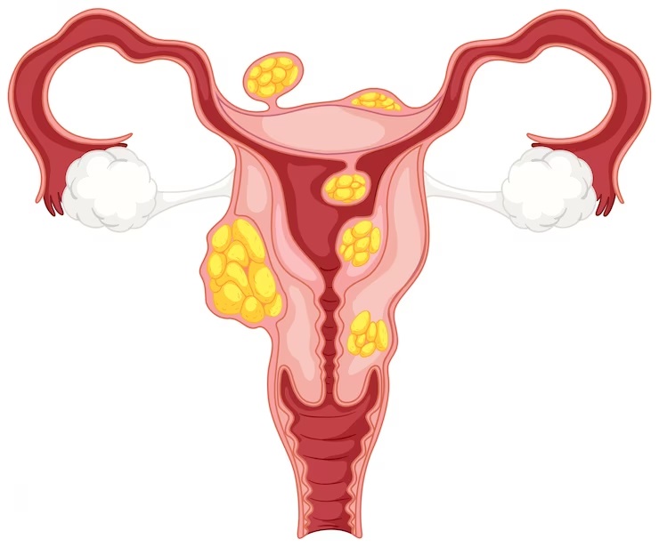 U xơ tử cung có làm ivf được không? Có cần bóc u xơ trước không?