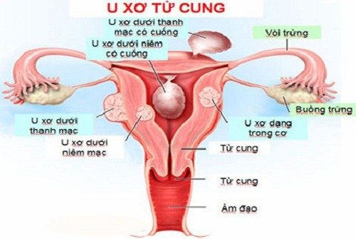 U xơ tử cung có lây không?