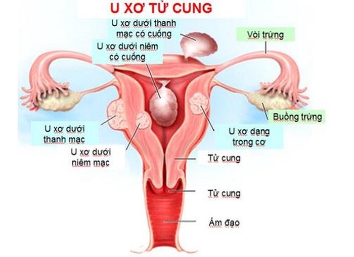 U xơ tử cung có mang thai được không?