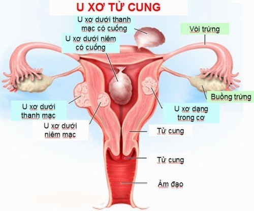 U xơ tử cung có thể mang thai được không?