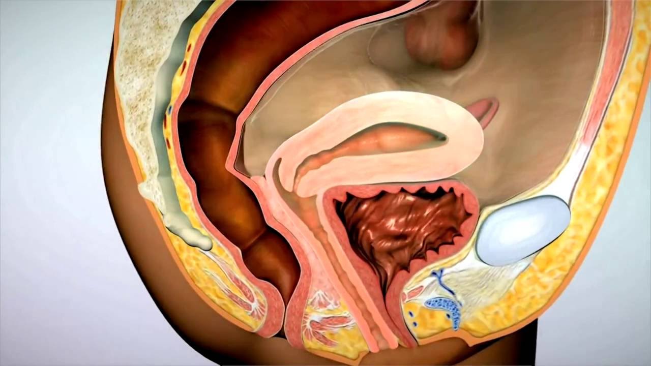 U xơ tử cung dạng adenomyosis: Nhận biết và phòng ngừa