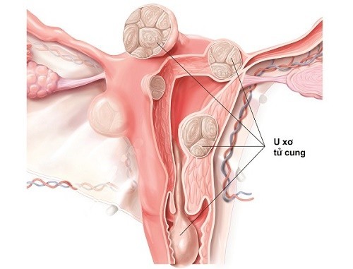 U xơ tử cung hỗ trợ điều trị thế nào?