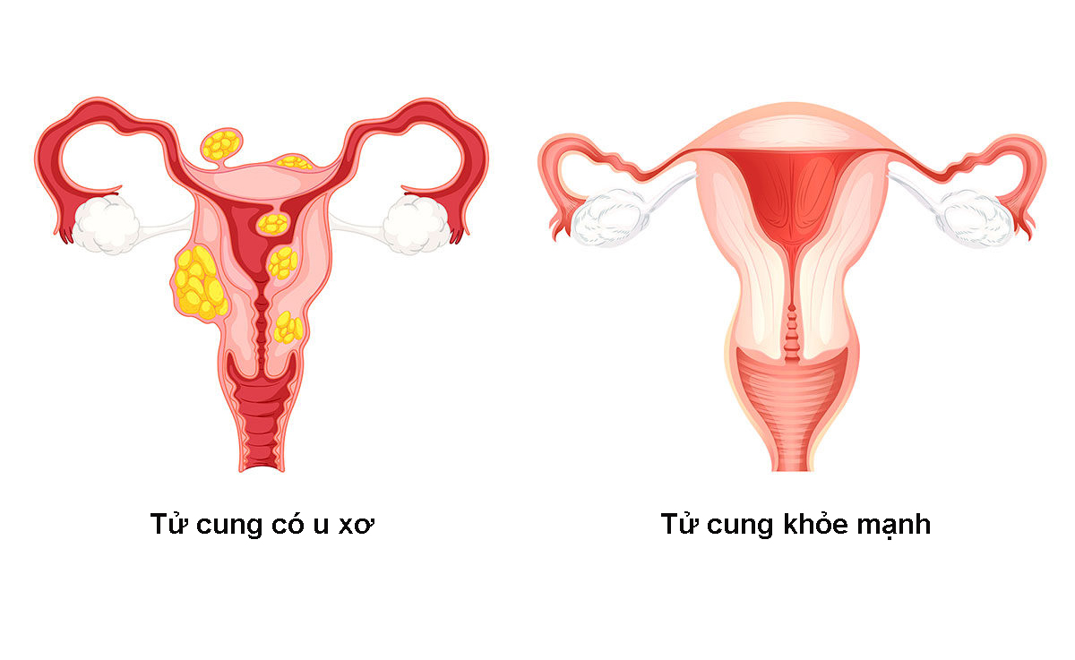 U xơ tử cung kiêng gì và nên ăn gì để hạn chế sự phát triển của u?