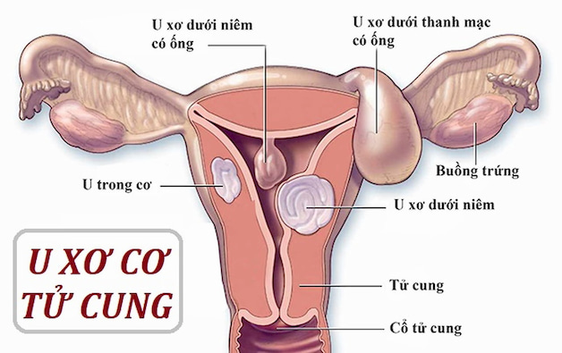 U xơ tử cung là gì có nguy hiểm không?