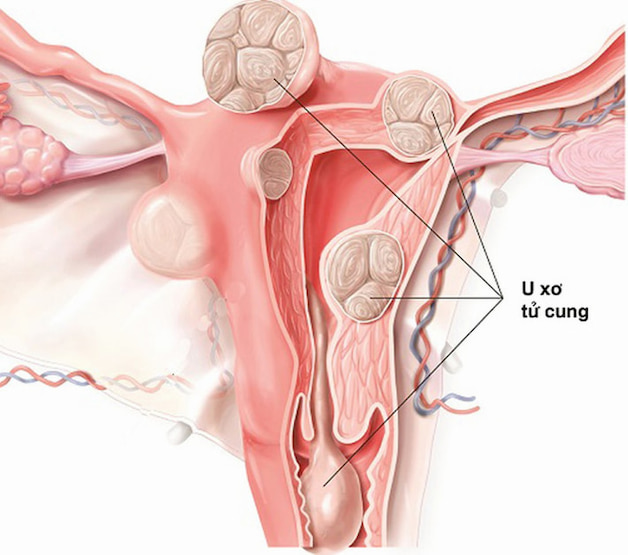 U xơ tử cung là gì có nguy hiểm không?