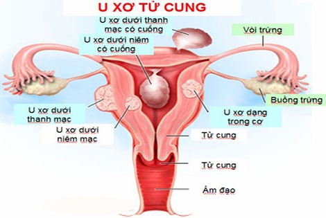 U xơ tử cung u nang buồng trứng khác nhau thế nào?